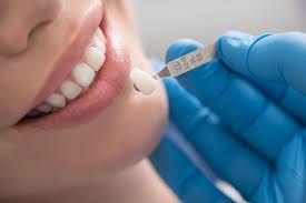Top Benefits Of Dental Veneers