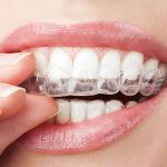 Unveiling The Total Cost Of Invisalign